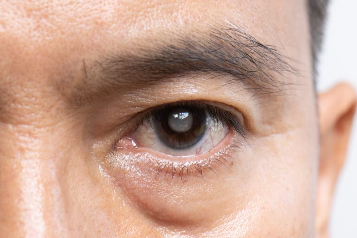 Close de olho humano com sinais de catarata em exame clínico